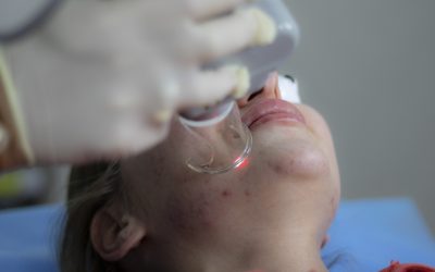 What To Consider Before Acne Scar Treatment